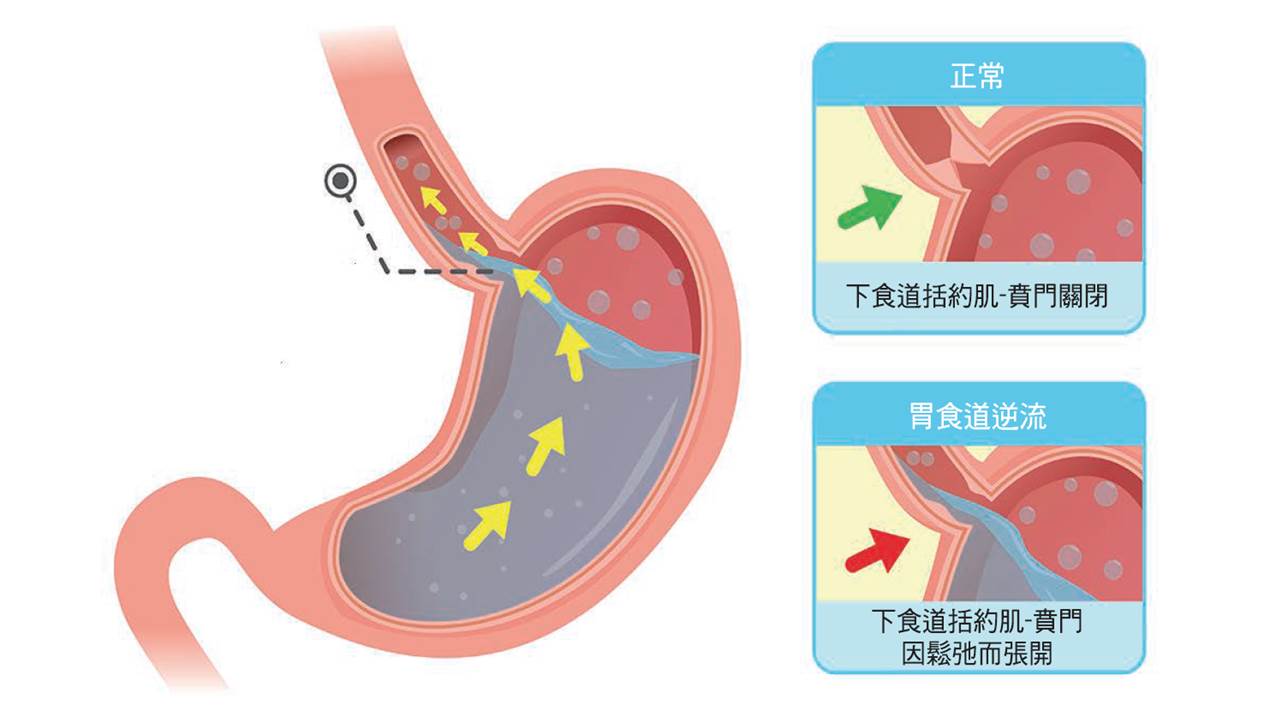 胃食道逆流的治療與防治 | 永越健康管理中心
