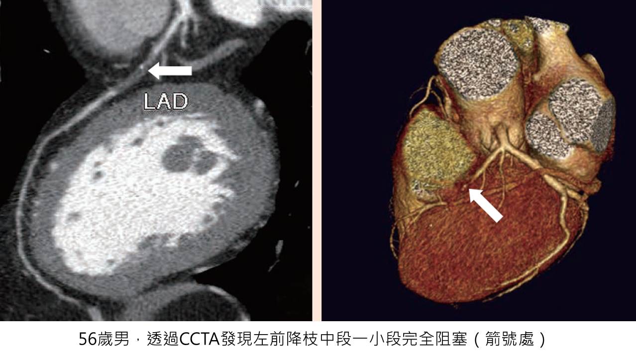 偵測冠心病的篩檢利器 冠狀動脈電腦斷層血管攝影 永越健康管理中心