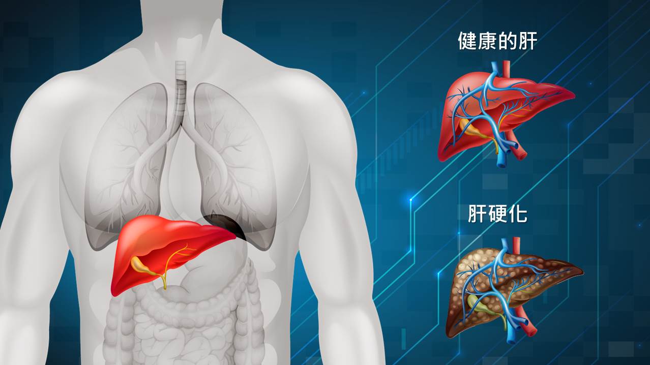 莫輕忽，其實您也可能是「肝苦人」 | 永越健康管理中心